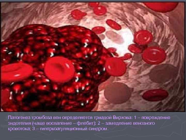 Механизмы тромбов. Повреждение эндотелия сосудов. Механизм развития тромба. Патогенез тромбоза. Этиология артериального тромбоза.
