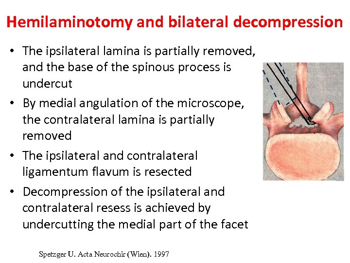 Hemilaminotomy and bilateral decompression • The ipsilateral lamina is partially removed, and the base