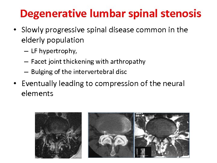 Degenerative lumbar spinal stenosis • Slowly progressive spinal disease common in the elderly population