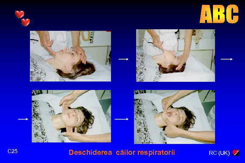 C 25 Deschiderea căilor respiratorii RC (UK) 