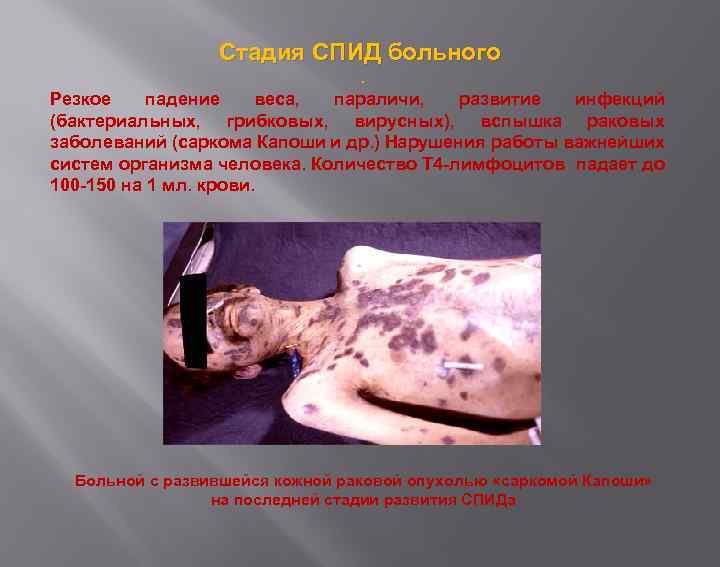 Стадия СПИД больного. Резкое падение веса, параличи, развитие инфекций (бактериальных, грибковых, вирусных), вспышка раковых