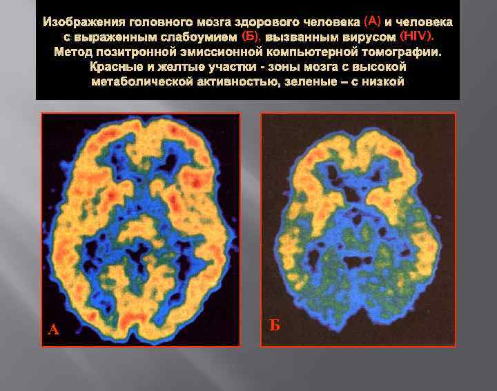 Изображения головного мозга здорового человека (А) и человека с выраженным слабоумием (Б), вызванным вирусом