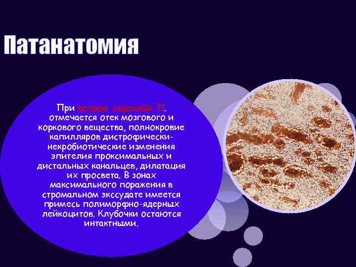 Патанатомия При остром серозном П. отмечается отек мозгового и коркового вещества, полнокровие капилляров дистрофическинекробиотические