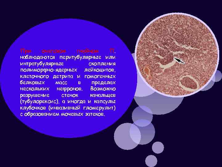 При очаговом гнойном П. наблюдаются перитубулярные или интратубулярные скопления полиморфно-ядерных лейкоцитов, клеточного детрита и