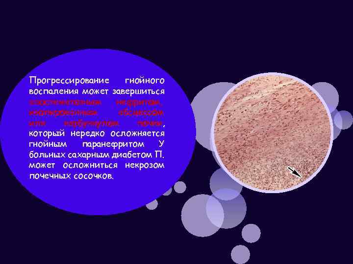 Прогрессирование гнойного воспаления может завершиться апостематозным нефритом, изолированным абсцессом или карбункулом почки, который нередко