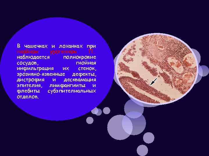 В чашечках и лоханках при гнойном урогенном П. наблюдается полнокровие сосудов, гнойная инфильтрация их