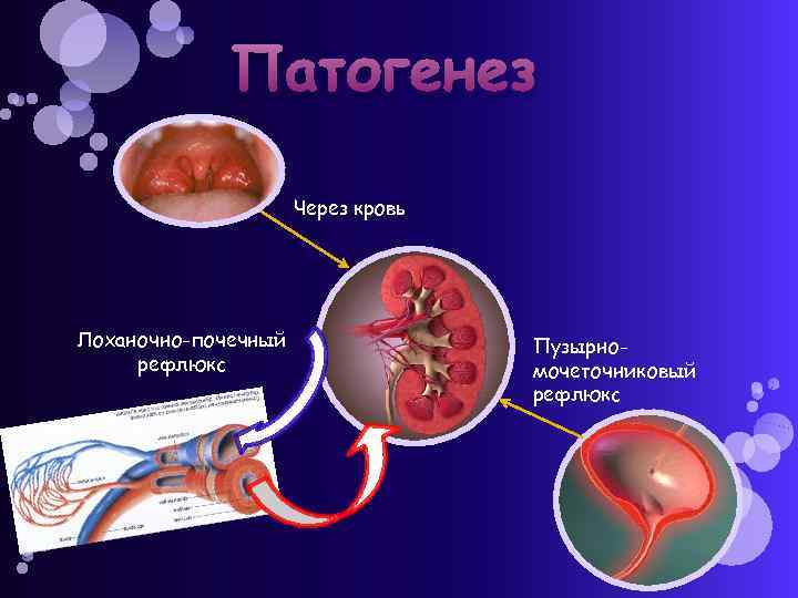 Патогенез Через кровь Лоханочно-почечный рефлюкс Пузырномочеточниковый рефлюкс 