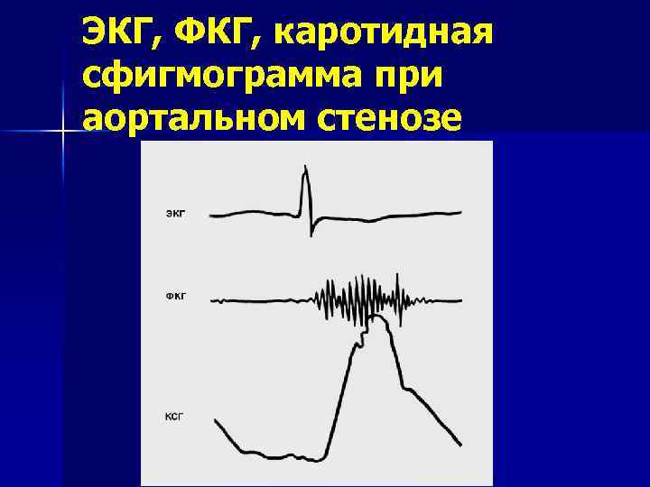 ЭКГ, ФКГ, каротидная сфигмограмма при аортальном стенозе 