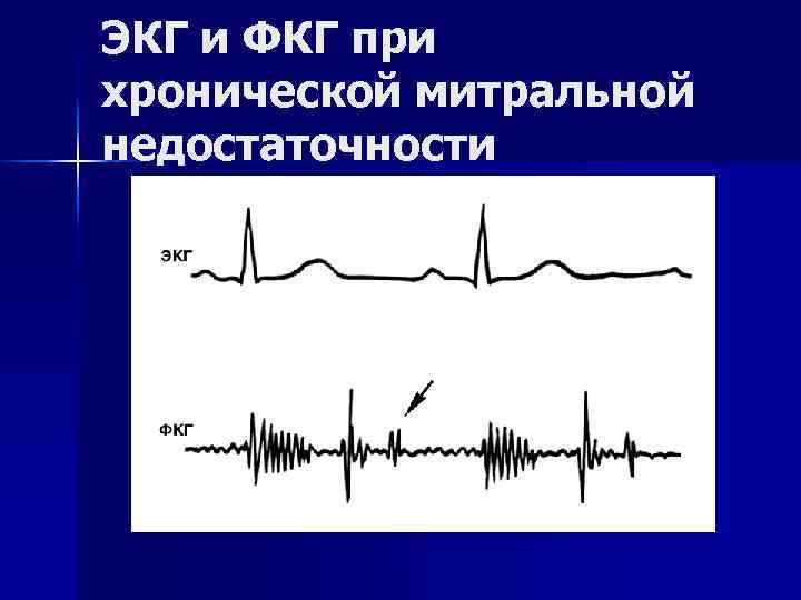 ЭКГ и ФКГ при хронической митральной недостаточности 