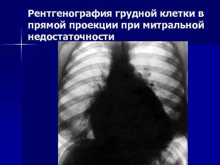 Рентгенография грудной клетки в прямой проекции при митральной недостаточности 