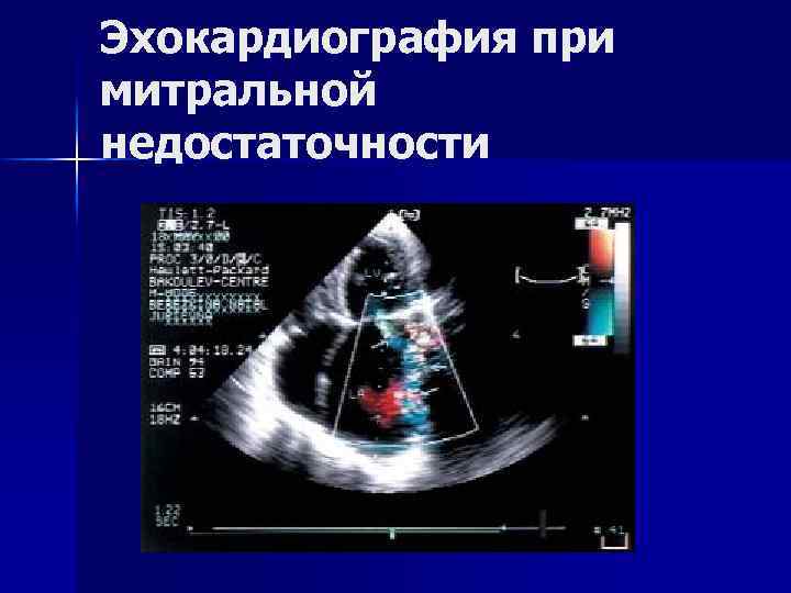Эхокардиография при митральной недостаточности 