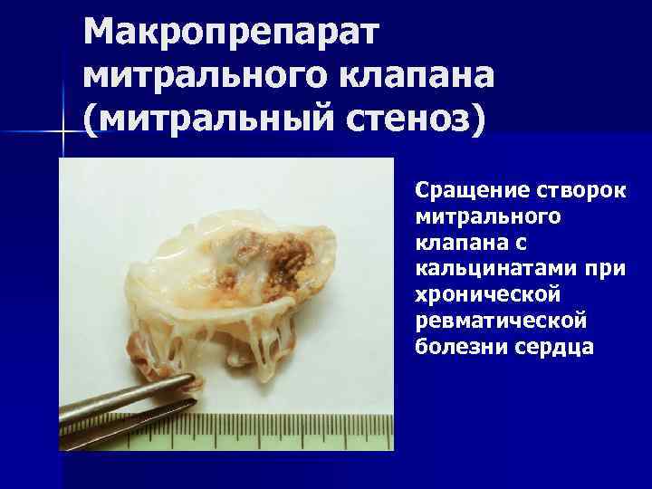 Неревматические поражения митрального клапана