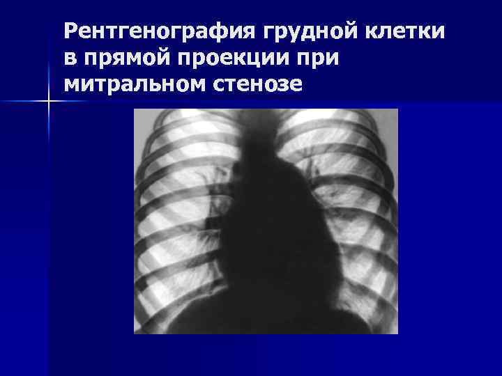 Рентгенография грудной клетки в прямой проекции при митральном стенозе 