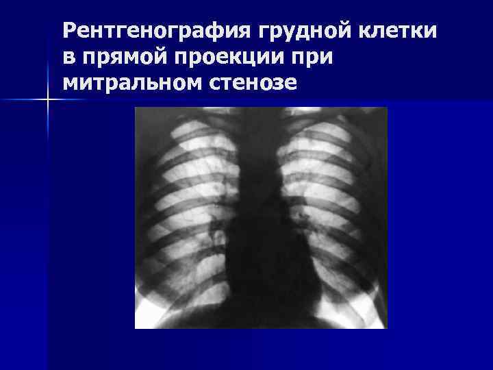 Рентгенография грудной клетки в прямой проекции при митральном стенозе 