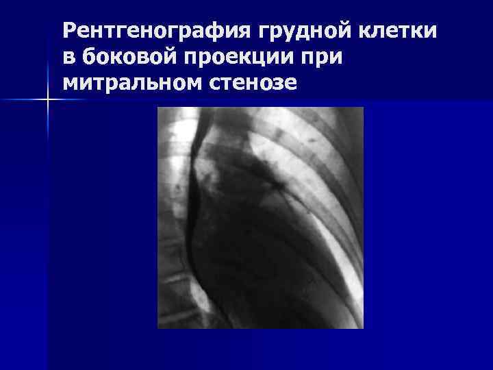 Рентгенография грудной клетки в боковой проекции при митральном стенозе 