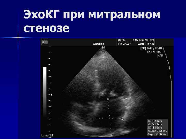 Эхо. КГ при митральном стенозе 