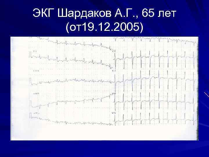 ЭКГ Шардаков А. Г. , 65 лет (от19. 12. 2005) 