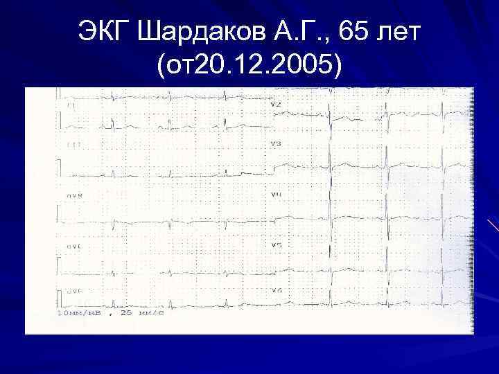 ЭКГ Шардаков А. Г. , 65 лет (от20. 12. 2005) 