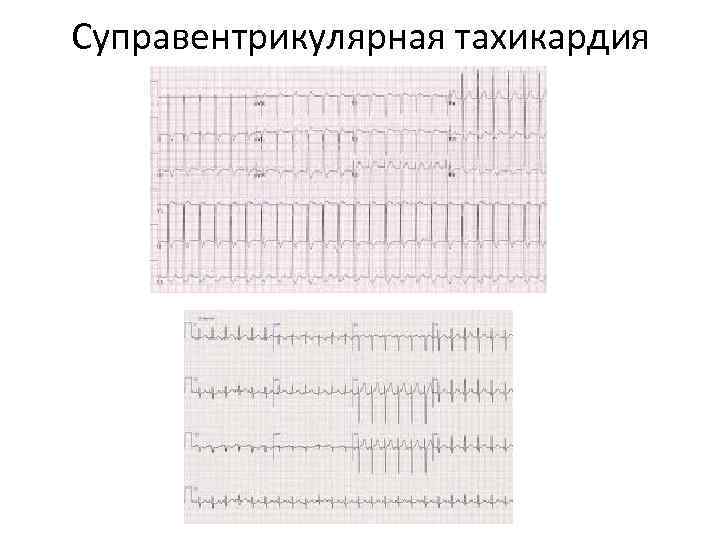 Суправентрикулярная тахикардия 
