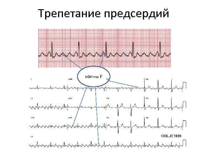 Волны при трепетании предсердий. Трепетание предсердий волны f. Волны f на ЭКГ трепетание предсердий. Волны фибрилляции на ЭКГ.