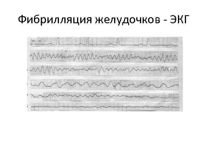 Фибрилляция желудочков - ЭКГ 