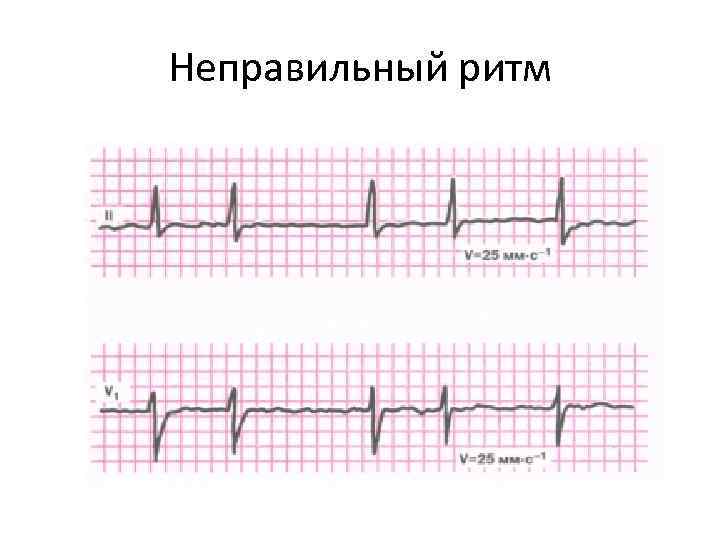 Неправильный ритм 
