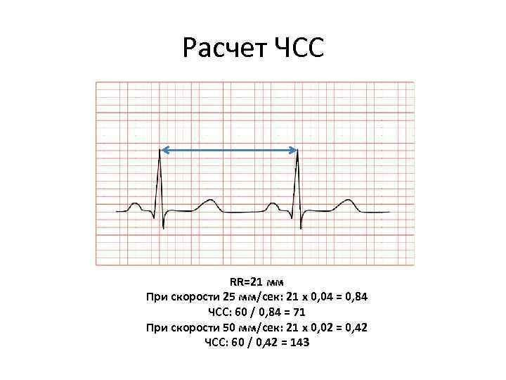 Расчет ЧСС RR=21 мм При скорости 25 мм/сек: 21 х 0, 04 = 0,