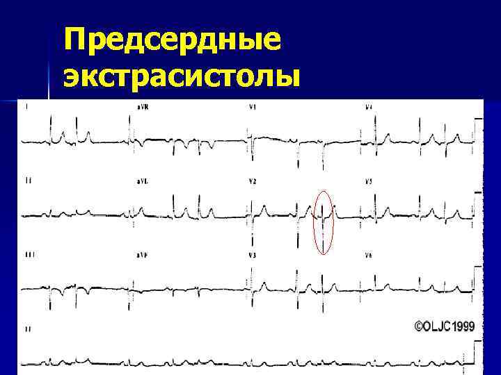 Предсердные экстрасистолы