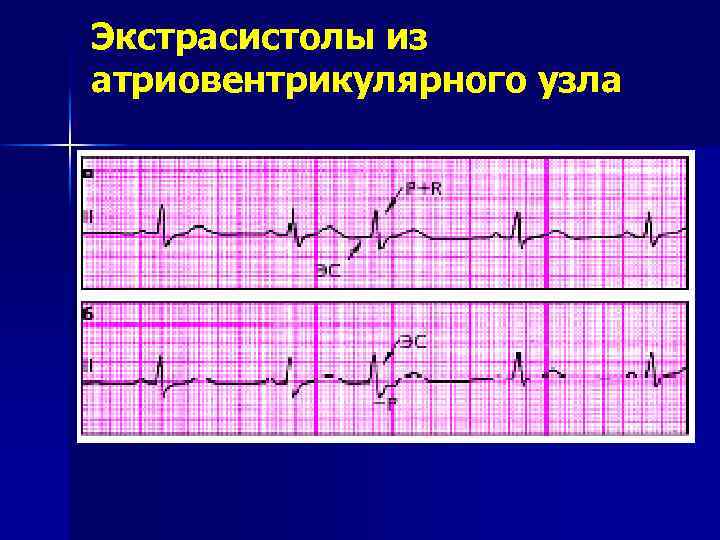 Экстрасистолы из атриовентрикулярного узла 
