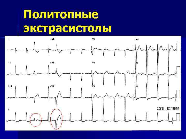 Как выглядит экстрасистолия на экг фото