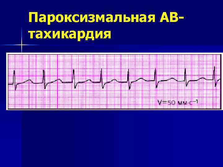 Пароксизмальная АВтахикардия 