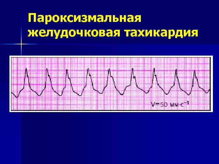 Пароксизмальная тахикардия это. Пароксизмальная желудочковая тахикардия. Пароксизм желудочковой тахикардии. Наджелудочковая аритмия ЭКГ. Синусовая тахикардия желудочковая.