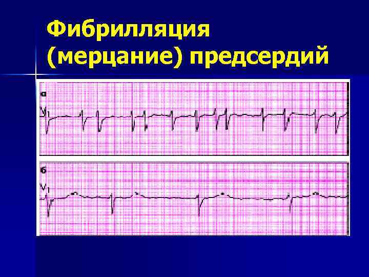 Мерцание предсердий на экг фото