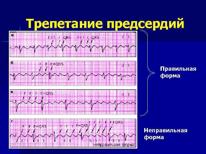 Персистирующее трепетание предсердий