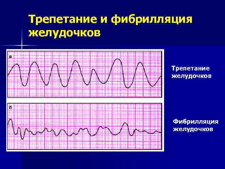 Фибрилляция желудочков фото