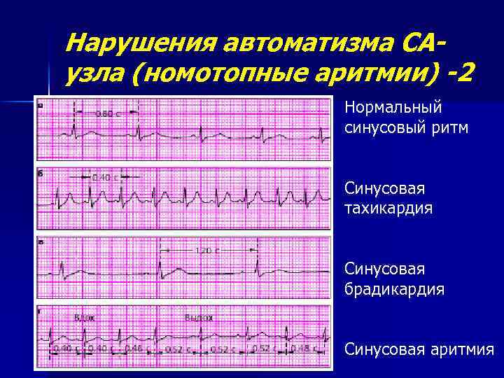 Что значит синусовый ритм сердца на экг. Синусовый ритм 75. Синусовая аритмия на ЭКГ. Синусовая Мерцательная аритмия ЭКГ. Синусовая брадикардия на ЭКГ.