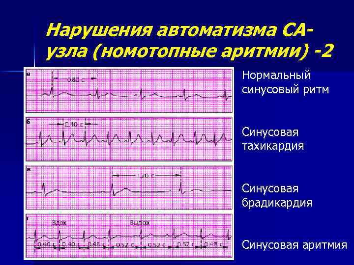 Аритмия и тахикардия. ЭКГ брадикардия синусовый ритм. Синусовая тахикардия с нарушением ритма на ЭКГ. ЭКГ при синусовой брадикардии и аритмии. Нарушение АВТОМАТИЗМА В ЭКГ синусовая аритмия.