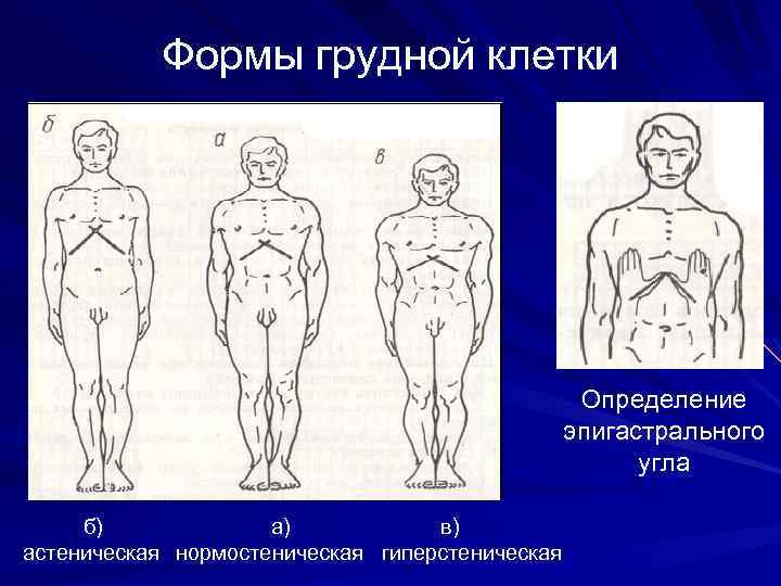 Рахитическая грудная клетка рисунок схематично