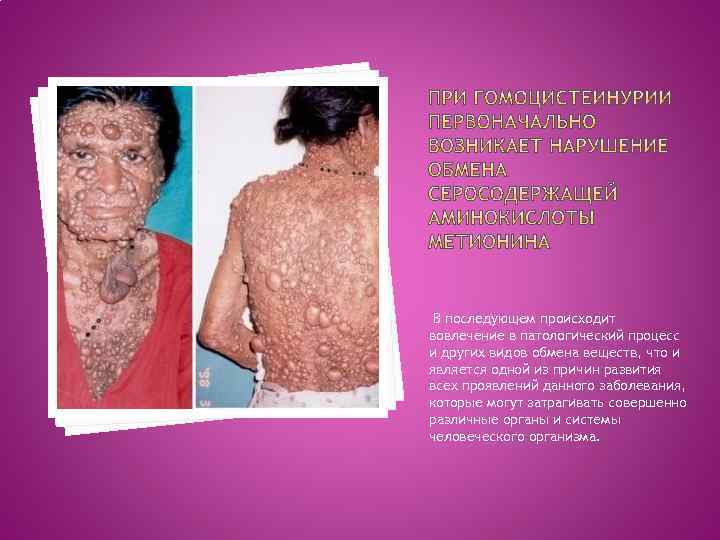 В последующем происходит вовлечение в патологический процесс и других видов обмена веществ, что и