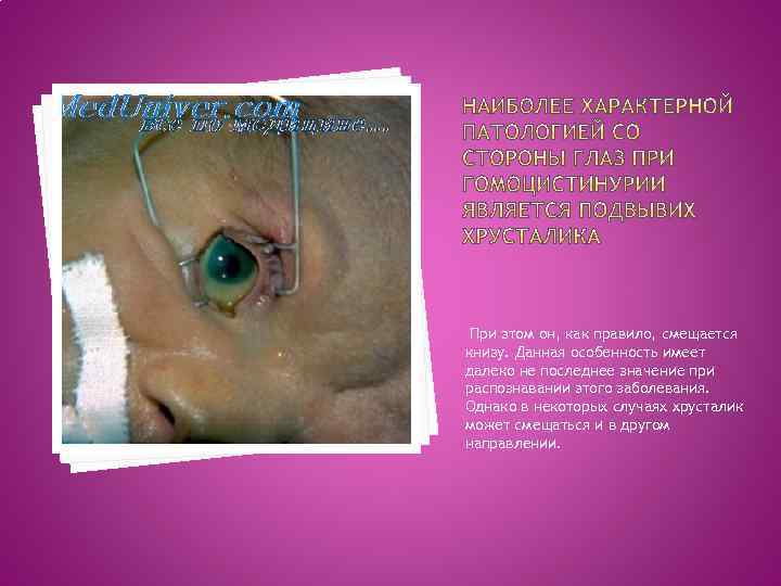 При этом он, как правило, смещается книзу. Данная особенность имеет далеко не последнее значение