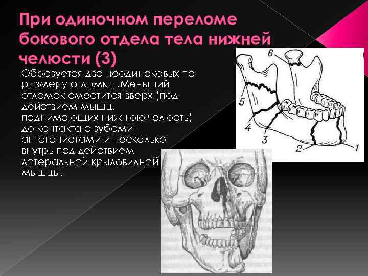 Перелом головки нижней челюсти