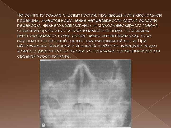 Закрытый перелом костей носа карта вызова