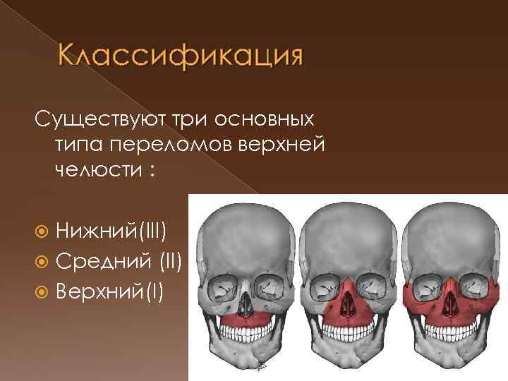 Перелом верхней челюсти презентация