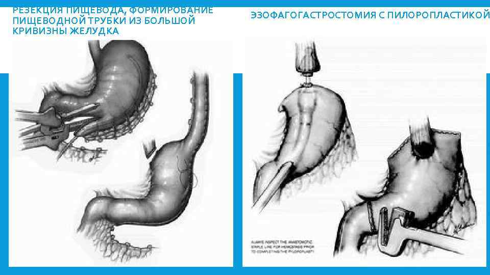 Резекция желудка отзывы