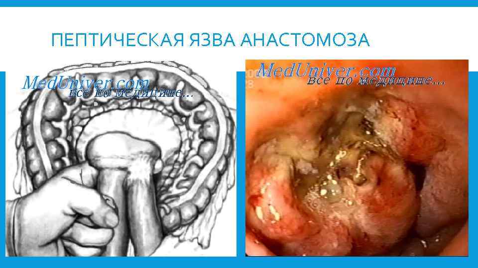 ПЕПТИЧЕСКАЯ ЯЗВА АНАСТОМОЗА 