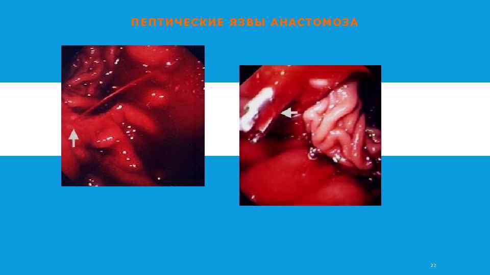 ПЕПТИЧЕСКИЕ ЯЗВЫ АНАСТОМОЗА 22 