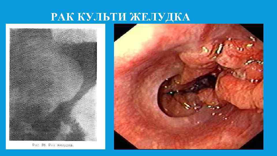 ГАСТРИТ КУЛЬТИ ЖЕЛУДКА РАК КУЛЬТИ ЖЕЛУДКА 