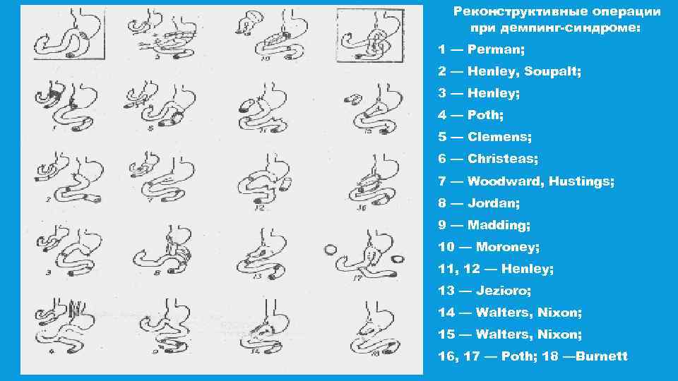 Реконструктивные операции при демпинг-синдроме: 1 — Реrmаn; 2 — Henley, Soupalt; 3 — Henley;