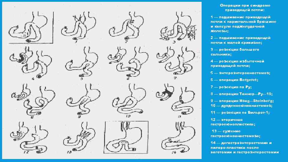 Операции при синдроме приводящей петли: 1 — подшивание приводящей петли к париетальной брюшине и