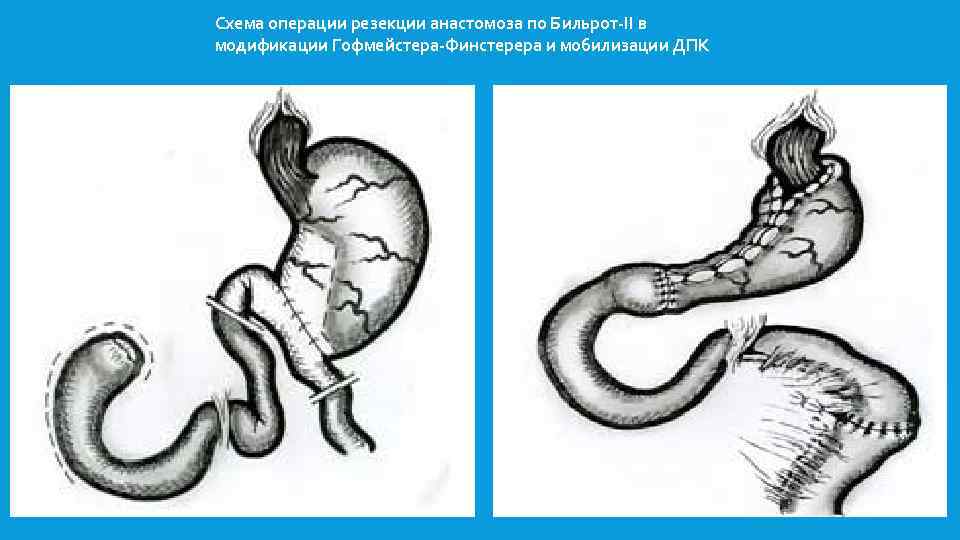 Анастомоз по брауну схема